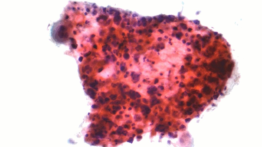 非小細胞肺癌 (NSCLC)