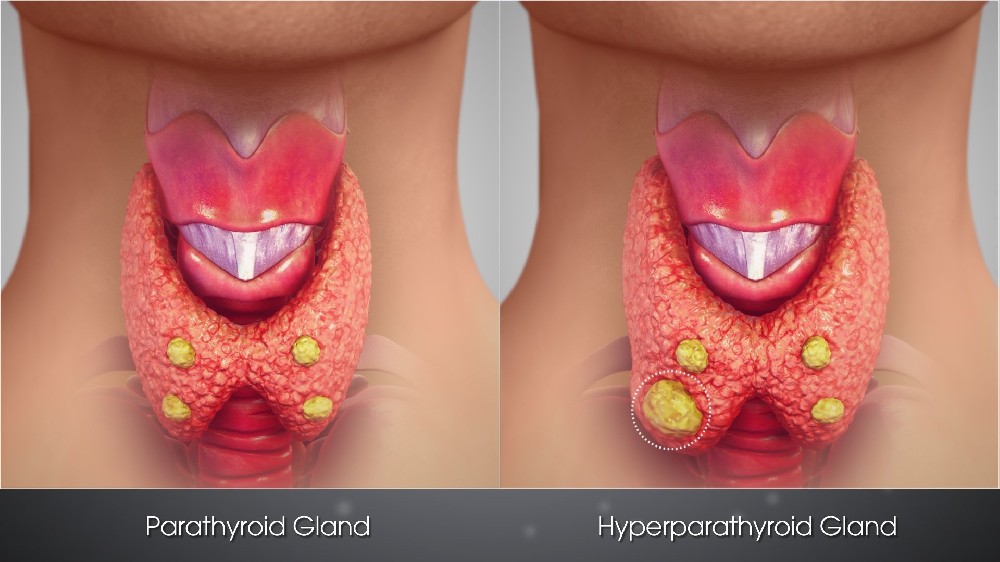 甲狀旁腺癌 (Parathyroid Carcinoma)