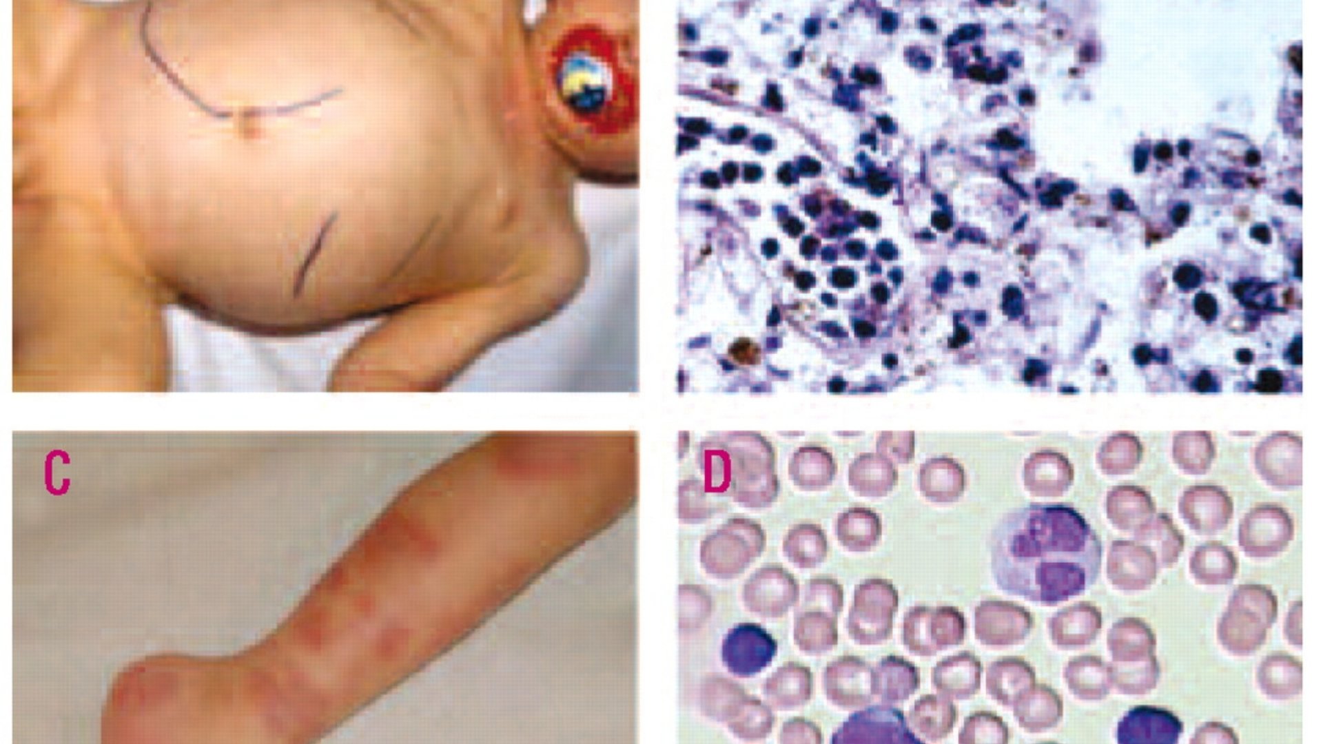 幼年髓單核細胞白血病 (JMML) 1 幼年髓單核細胞白血病 JMML