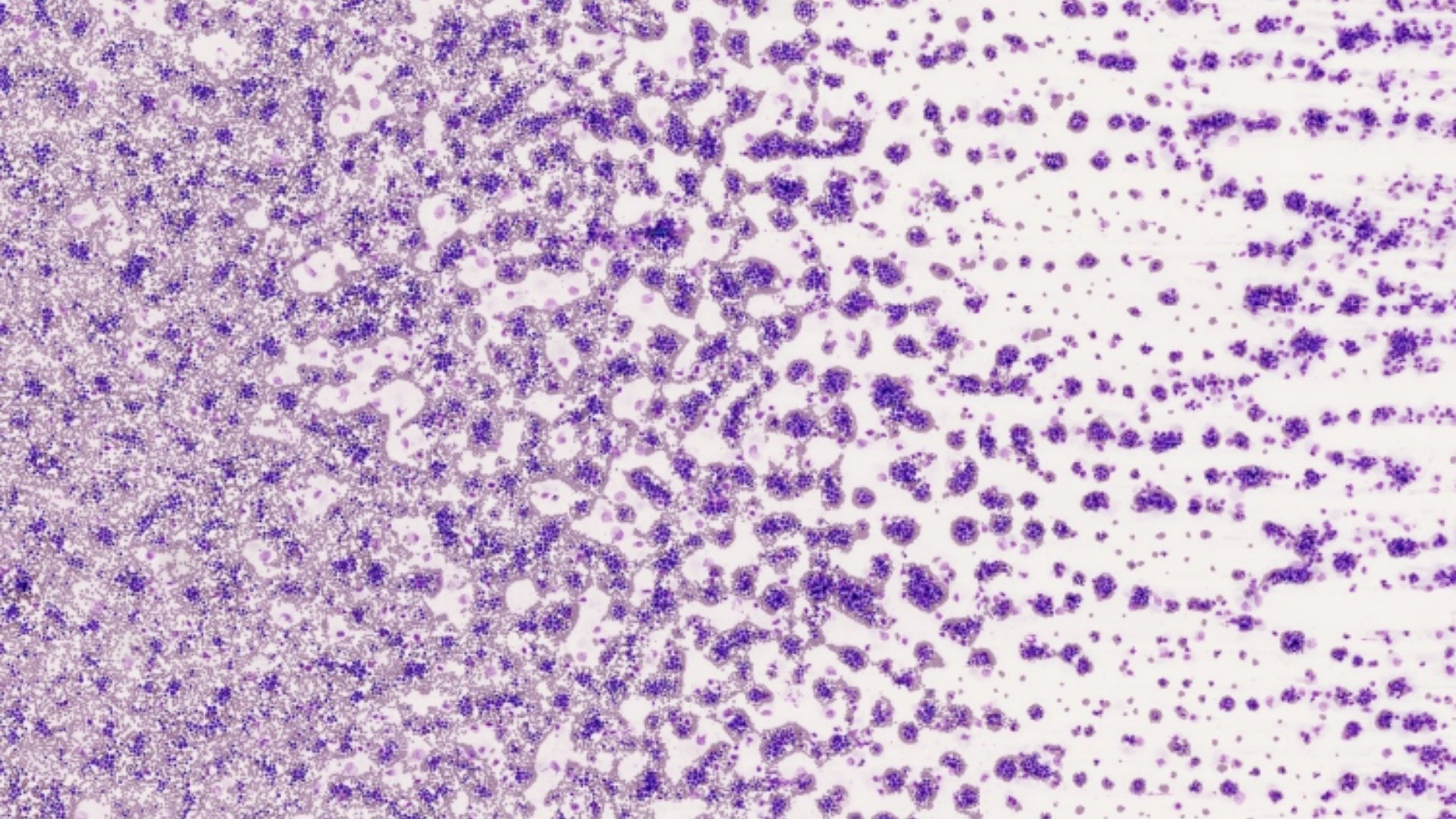 慢性骨髓性白血病 (CML) 1 慢性骨髓性白血病 (CML)