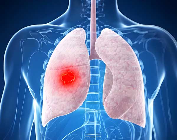 肺4.jpg